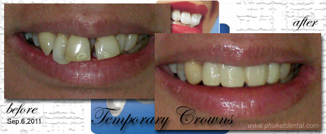 Temporary Crowns&Bridges at Phuket Dental Clinic,Thailand